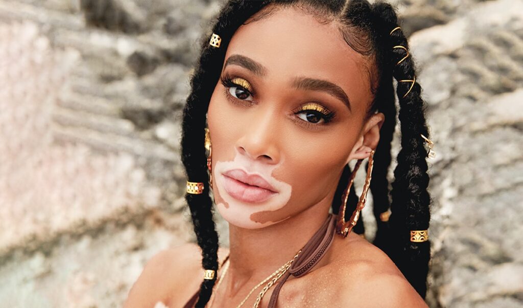 Winnie Harlow Winnie Harlow