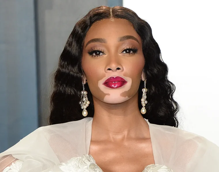 z czego znana jest Winnie Harlow
